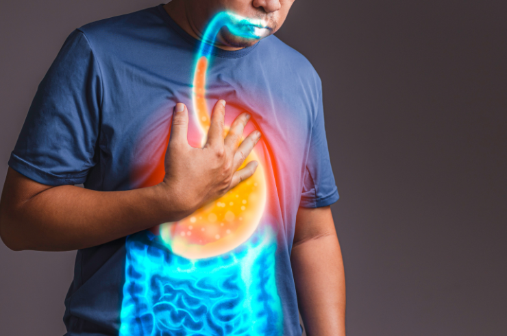 Gastroesophageal Reflux Disease